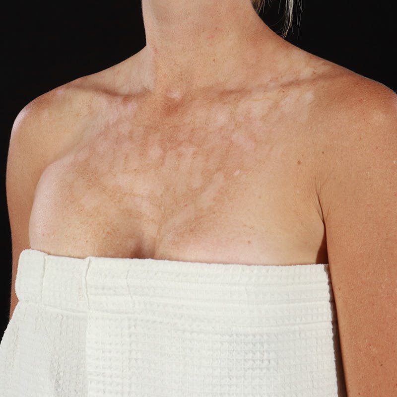 BroadBand Light™ Therapy Before & After Gallery - Patient 296700 - Image 5