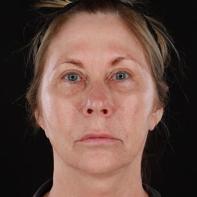HALO™ Laser Treatment Before & After Gallery - Patient 149019 - Image 1