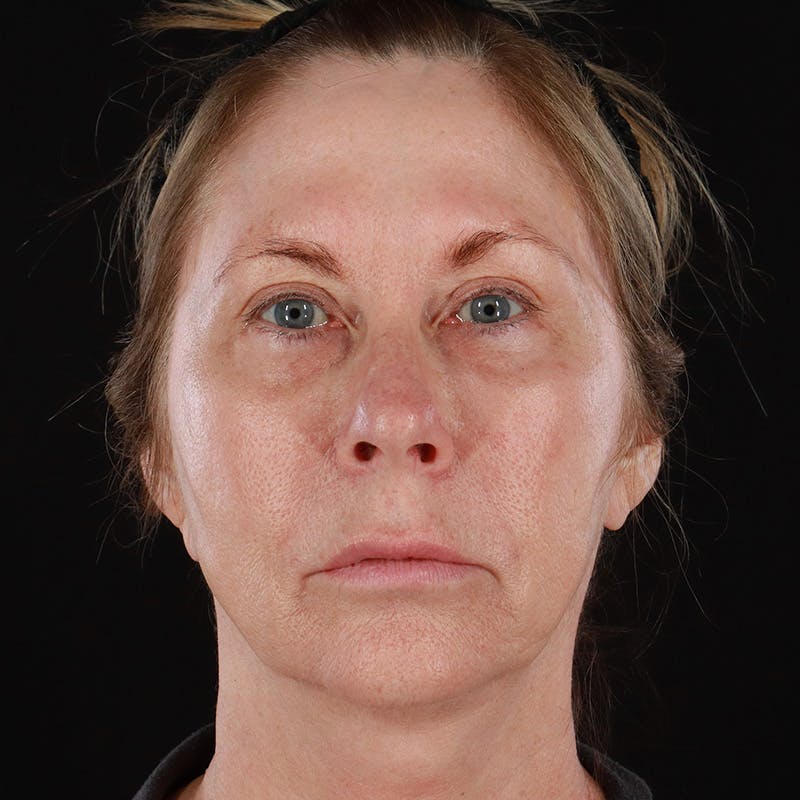 BroadBand Light™ Therapy Before & After Gallery - Patient 390276 - Image 1