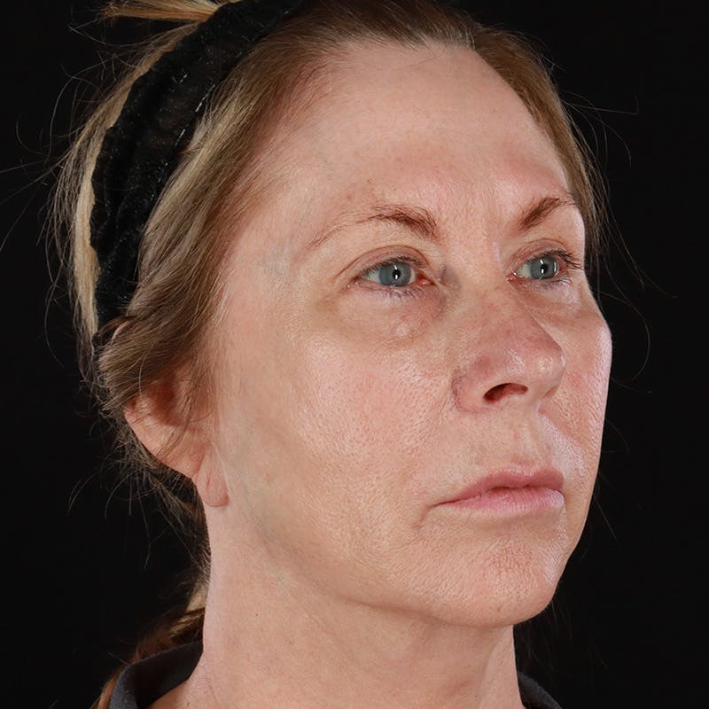 HALO™ Laser Treatment Before & After Gallery - Patient 149019 - Image 3