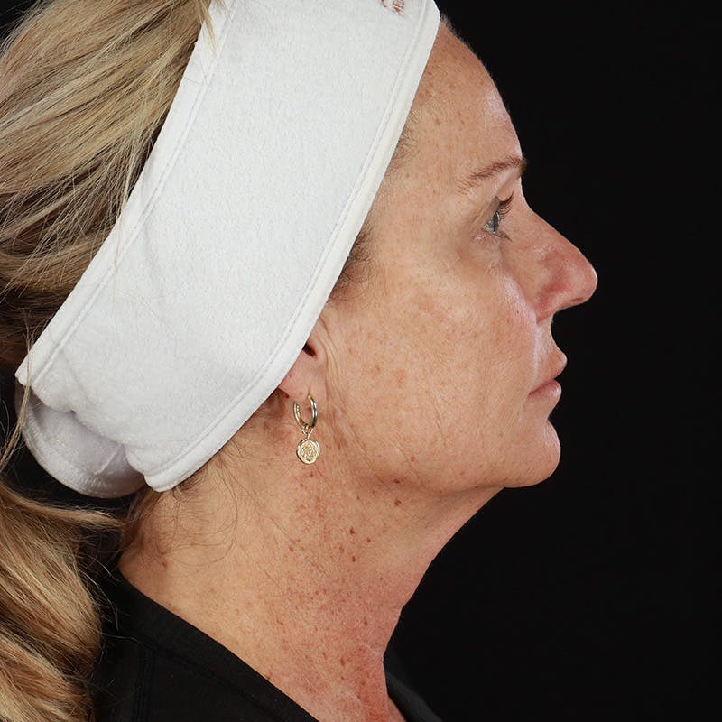 Morpheus8 Before & After Gallery - Patient 293895 - Image 5