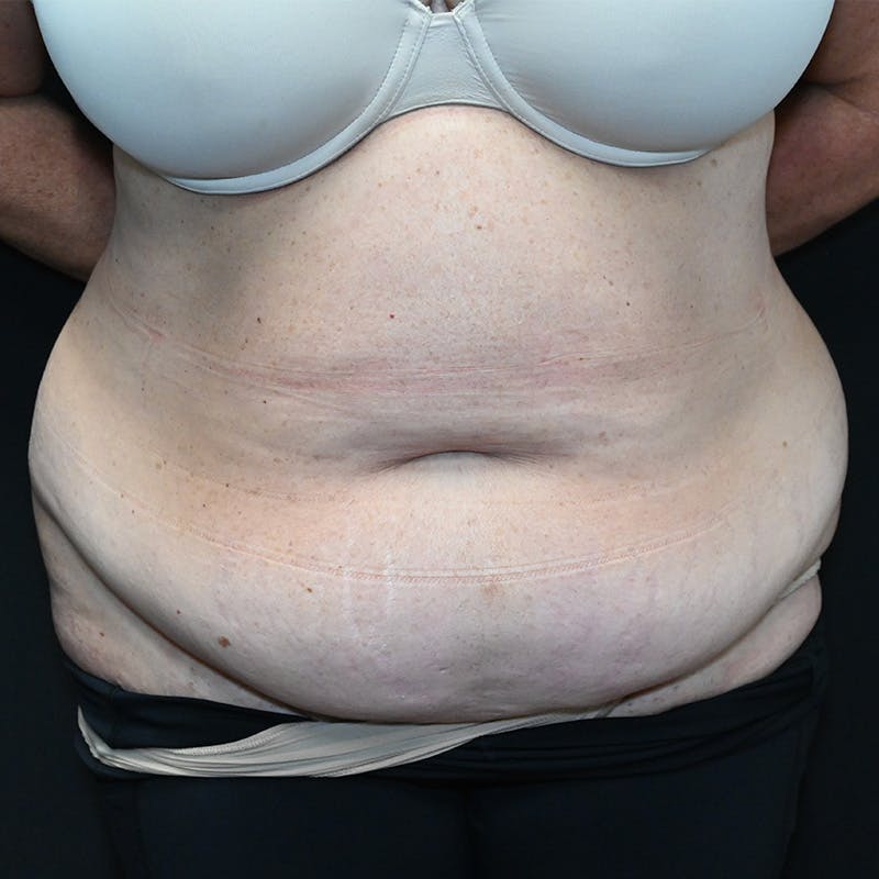 Abdominoplasty (Tummy Tuck) Before & After Gallery - Patient 352175 - Image 1