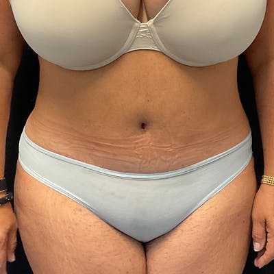 Abdominoplasty (Tummy Tuck) Before & After Gallery - Patient 352175 - Image 2