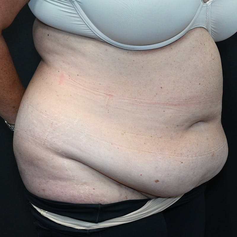 Abdominoplasty (Tummy Tuck) Before & After Gallery - Patient 352175 - Image 3