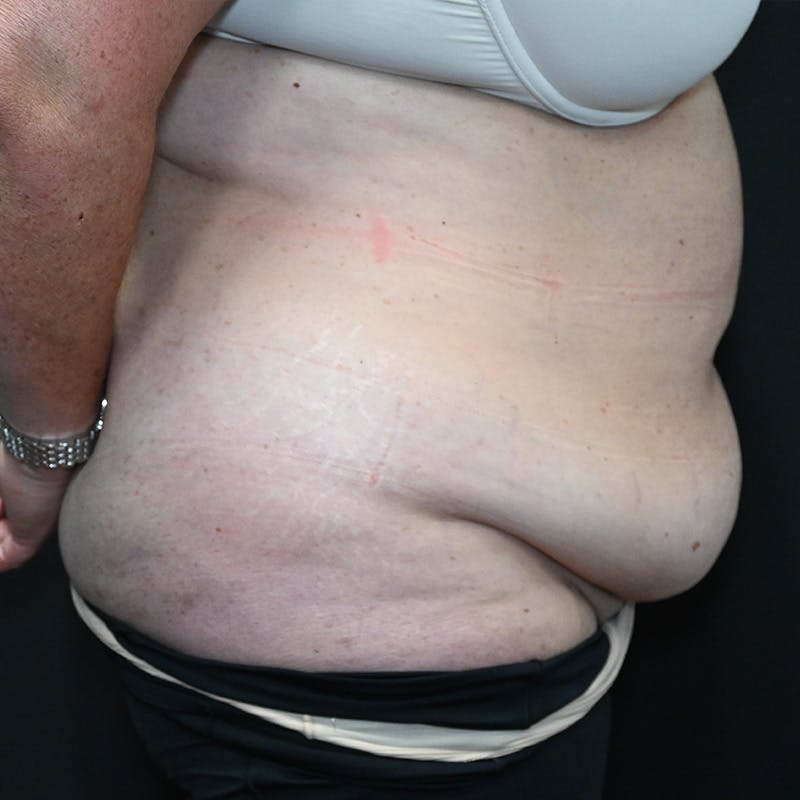 Abdominoplasty (Tummy Tuck) Before & After Gallery - Patient 352175 - Image 5