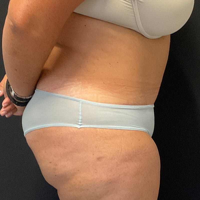 Abdominoplasty (Tummy Tuck) Before & After Gallery - Patient 352175 - Image 6
