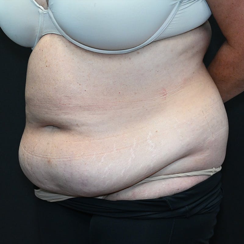 Abdominoplasty (Tummy Tuck) Before & After Gallery - Patient 352175 - Image 7