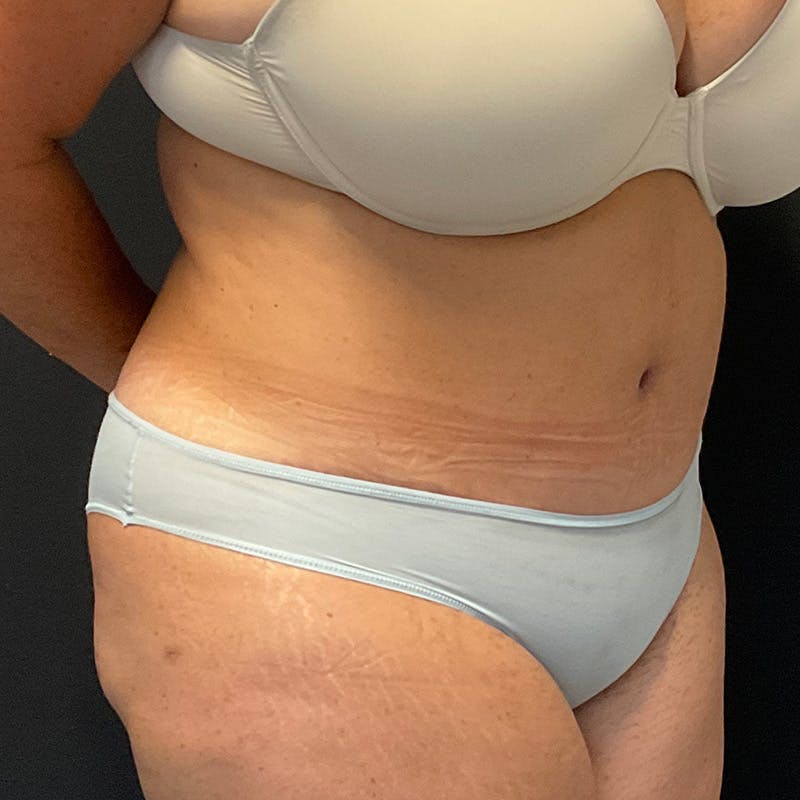 Abdominoplasty (Tummy Tuck) Before & After Gallery - Patient 352175 - Image 4