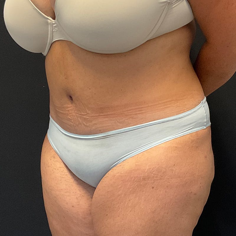 Abdominoplasty (Tummy Tuck) Before & After Gallery - Patient 352175 - Image 8