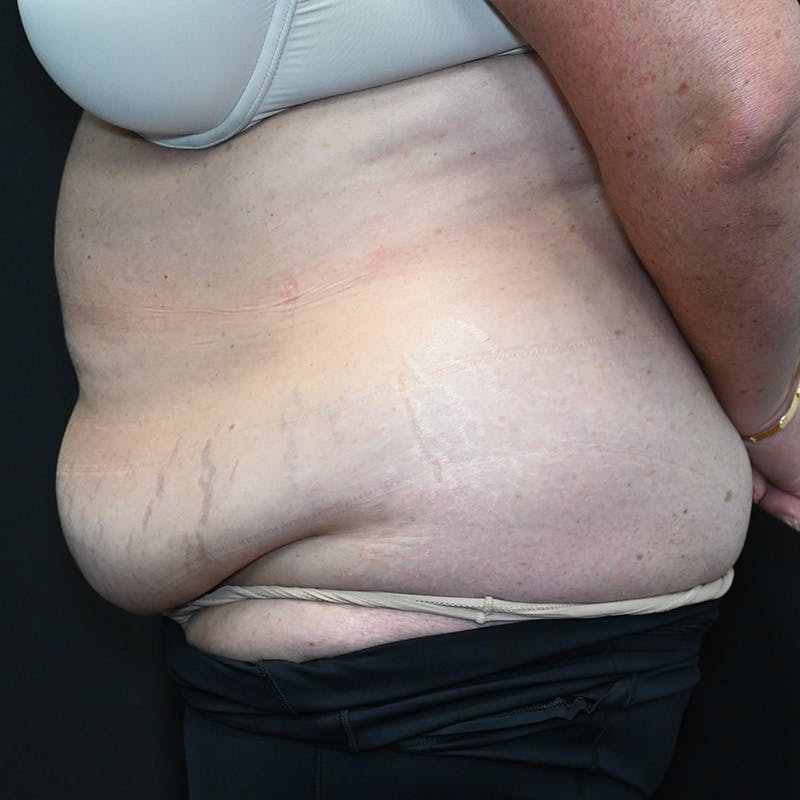 Abdominoplasty (Tummy Tuck) Before & After Gallery - Patient 352175 - Image 9