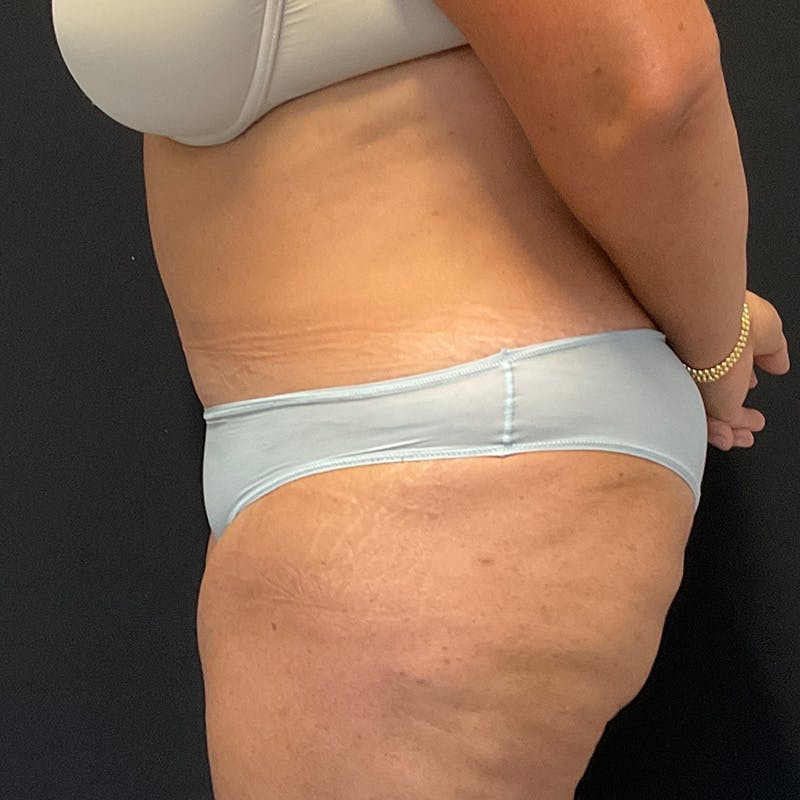 Abdominoplasty (Tummy Tuck) Before & After Gallery - Patient 352175 - Image 10