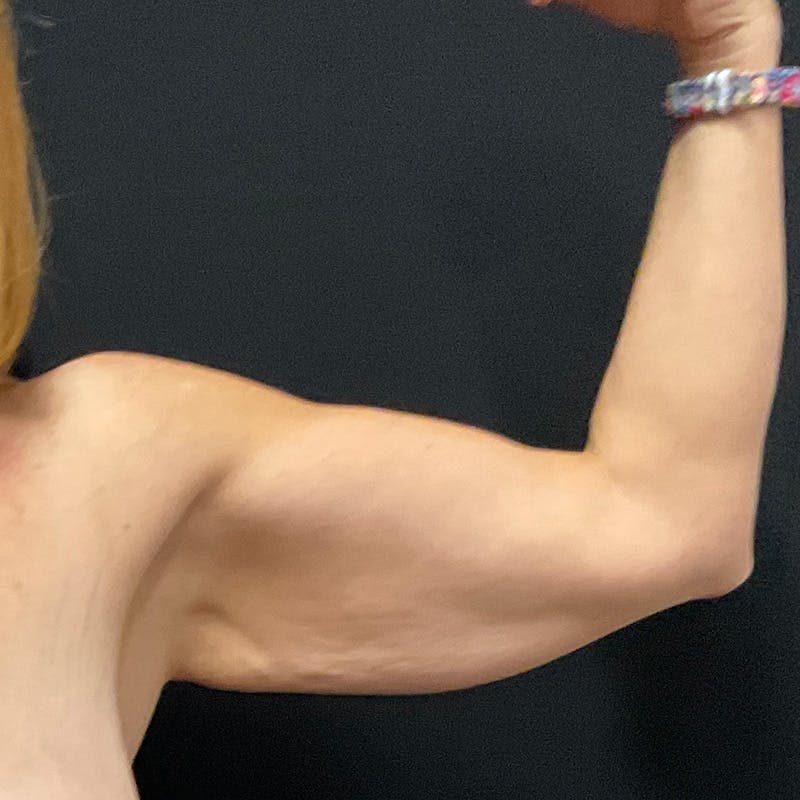 Arm Lift Before & After Gallery - Patient 152261 - Image 3