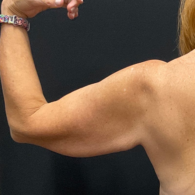 Arm Lift Before & After Gallery - Patient 152261 - Image 5