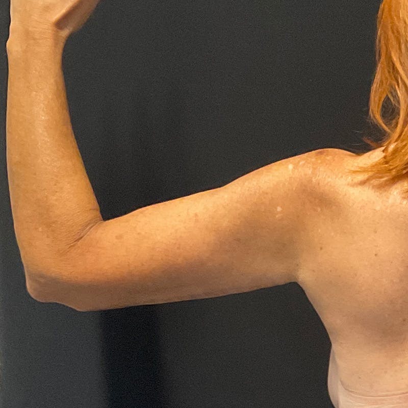 Arm Lift Before & After Gallery - Patient 152261 - Image 6
