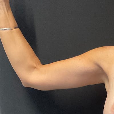 Arm Lift Before & After Gallery - Patient 152261 - Image 2