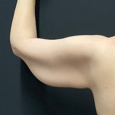 Arm Lift Before & After Gallery - Patient 140979 - Image 1