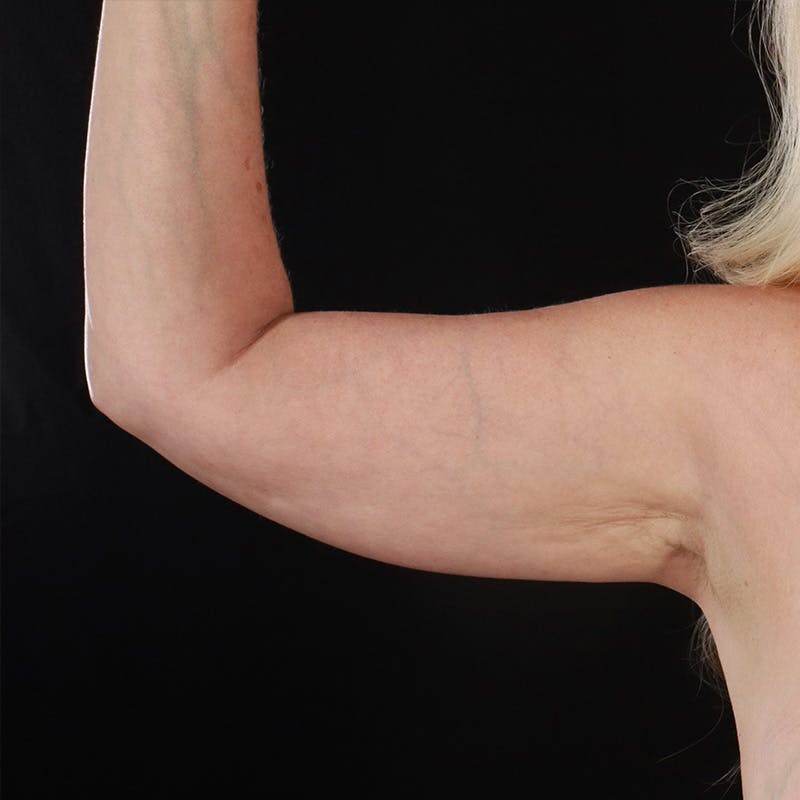 Arm Lift Before & After Gallery - Patient 330402 - Image 1