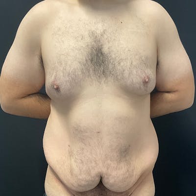 Body Lift Before & After Gallery - Patient 197418 - Image 1