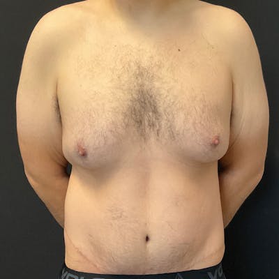 Body Lift Before & After Gallery - Patient 197418 - Image 2