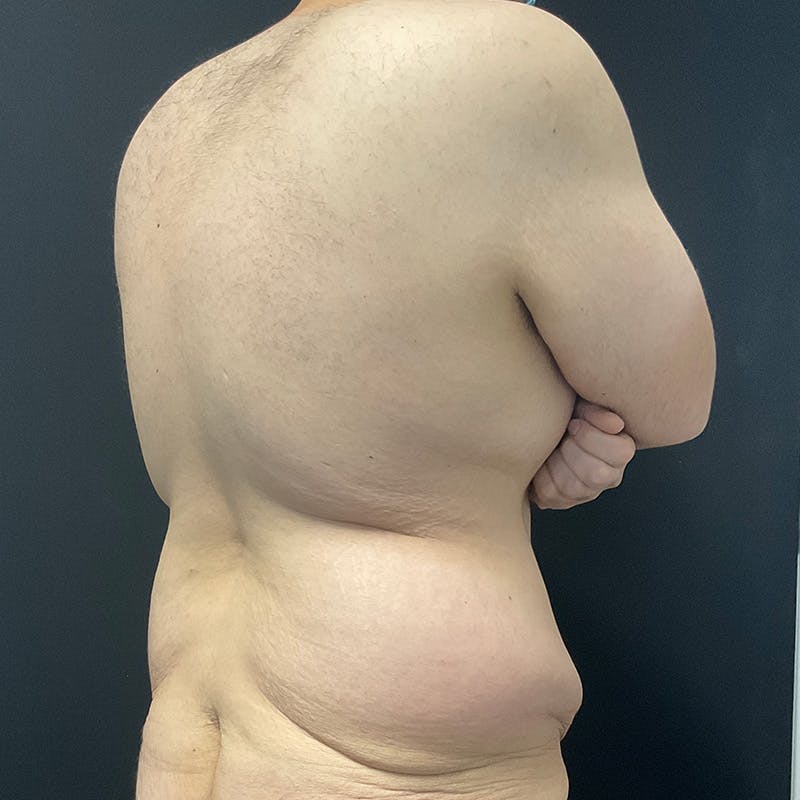 Body Lift Before & After Gallery - Patient 197418 - Image 7