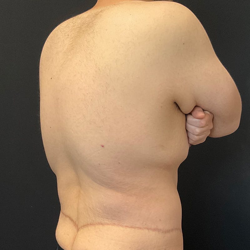 Body Lift Before & After Gallery - Patient 197418 - Image 8