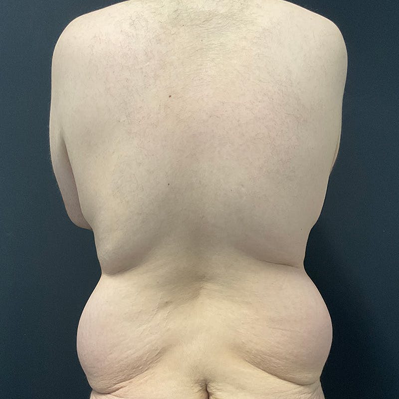 Body Lift Before & After Gallery - Patient 197418 - Image 9