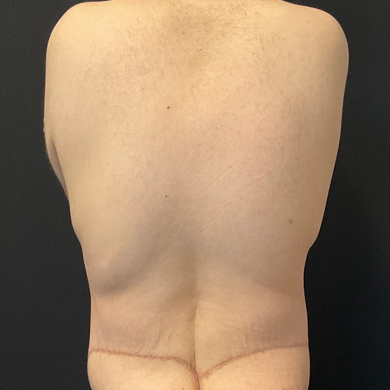 Body Lift Before & After Gallery - Patient 197418 - Image 10
