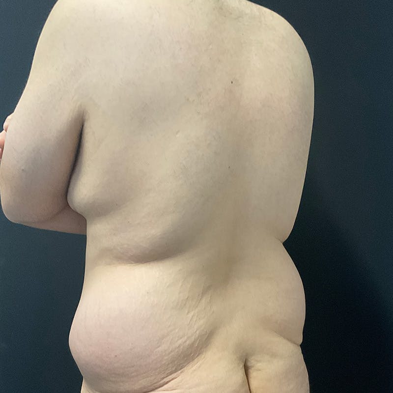 Body Lift Before & After Gallery - Patient 197418 - Image 11