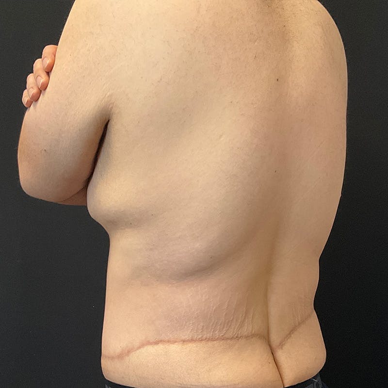 Body Lift Before & After Gallery - Patient 197418 - Image 12