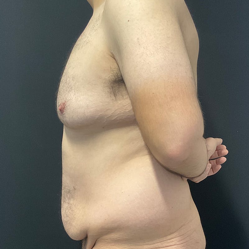 Body Lift Before & After Gallery - Patient 197418 - Image 13