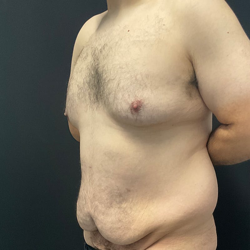Body Lift Before & After Gallery - Patient 197418 - Image 17