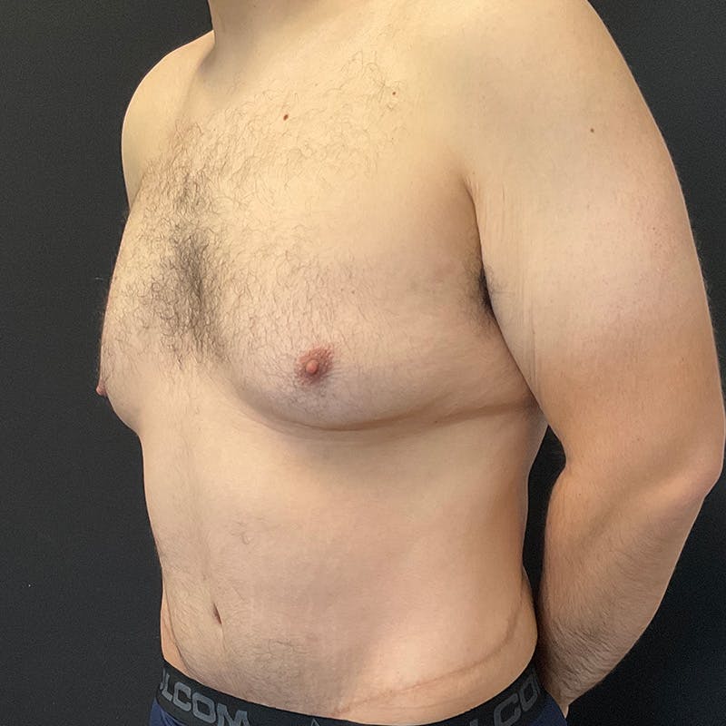 Body Lift Before & After Gallery - Patient 197418 - Image 18