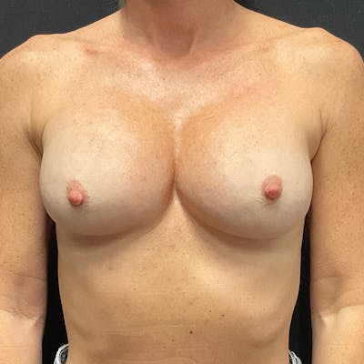 Breast Revision Before & After Gallery - Patient 161223 - Image 2