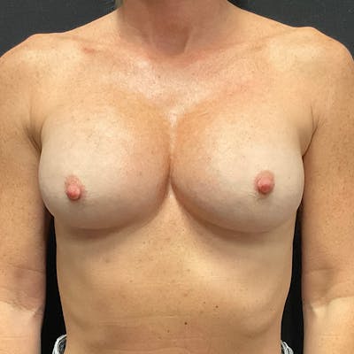 Breast Revision Before & After Gallery - Patient 161223 - Image 2