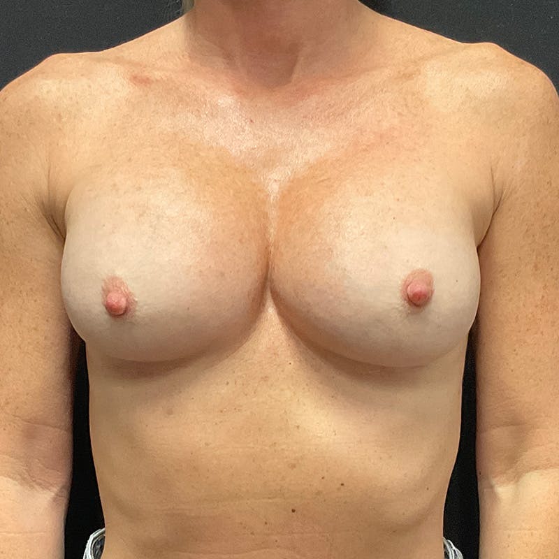 Breast Revision Before & After Gallery - Patient 161223 - Image 2