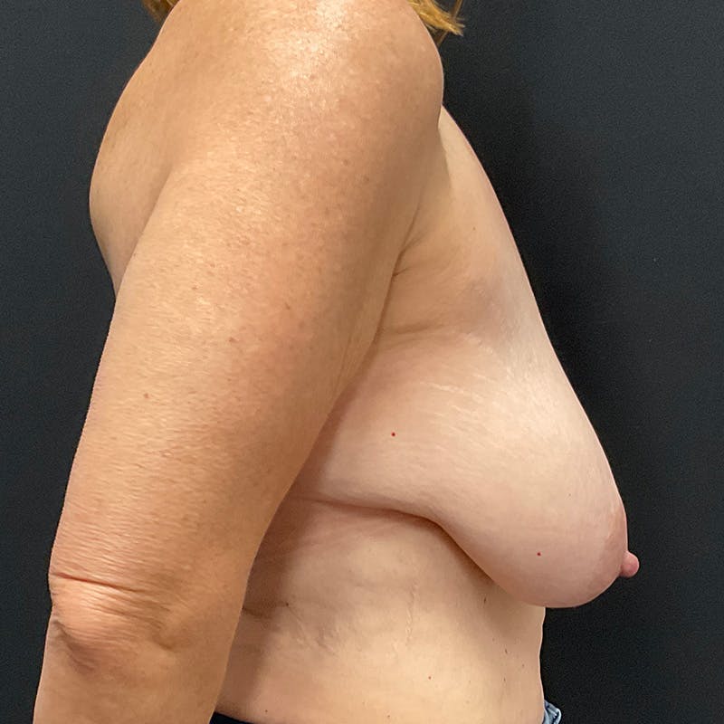 Breast Lift Before & After Gallery - Patient 478635 - Image 5
