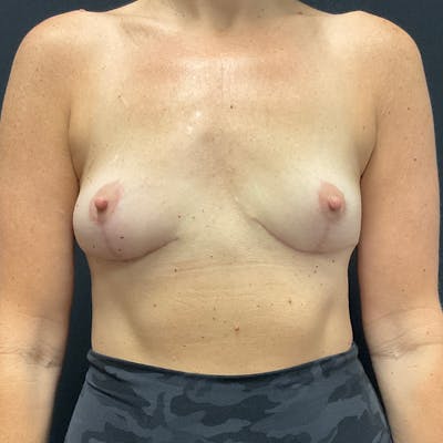 Breast Lift Before & After Gallery - Patient 124784 - Image 2