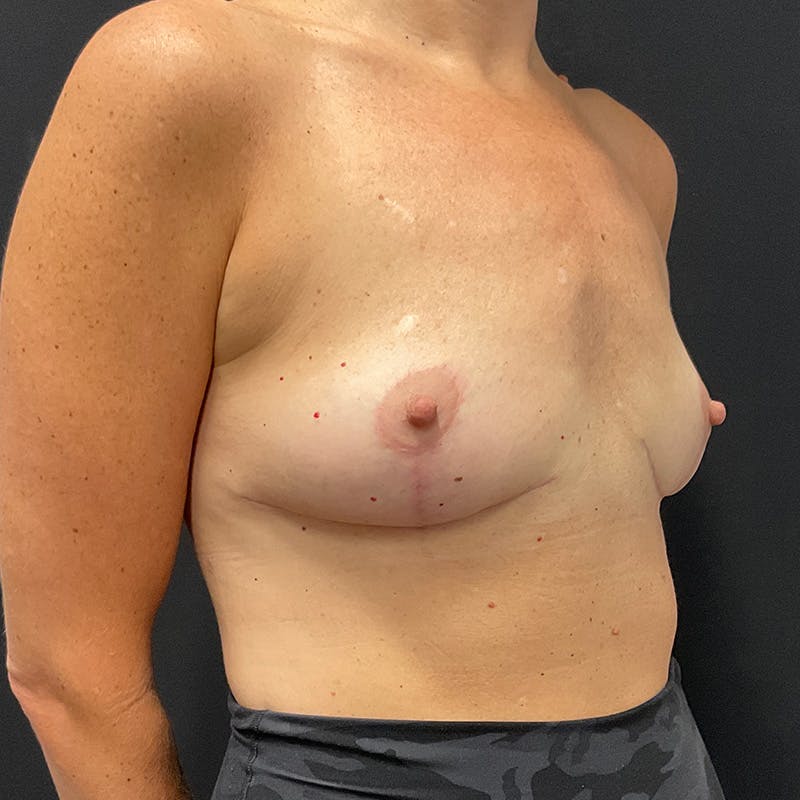 Breast Explant with Lift Before & After Gallery - Patient 105231 - Image 4