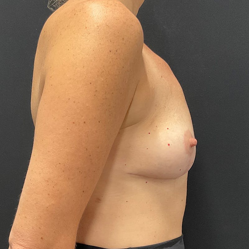 Breast Explant with Lift Before & After Gallery - Patient 105231 - Image 6