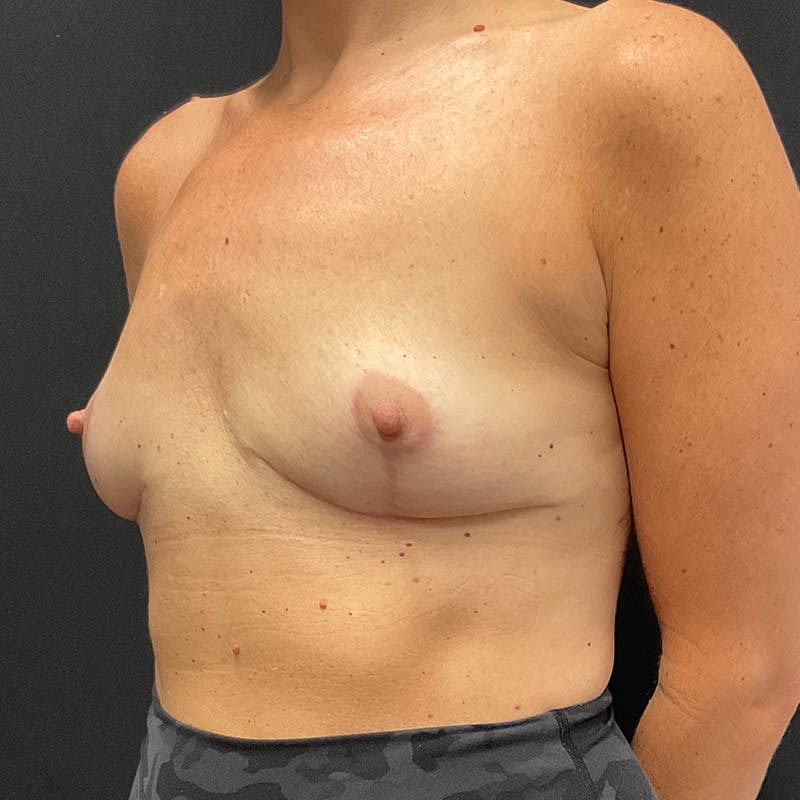 Breast Explant with Lift Before & After Gallery - Patient 105231 - Image 8