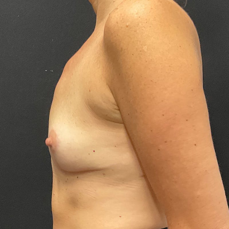 Breast Lift Before & After Gallery - Patient 124784 - Image 10