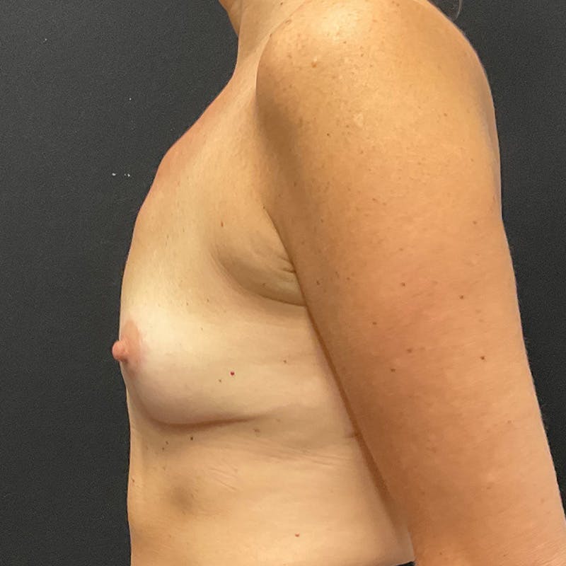 Breast Explant with Lift Before & After Gallery - Patient 105231 - Image 10