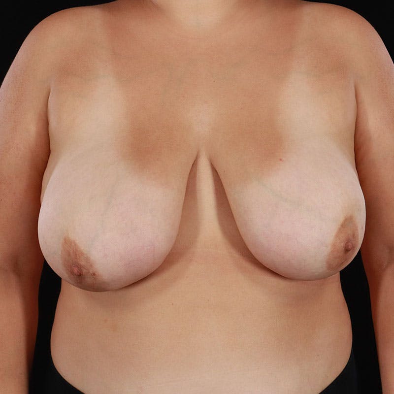 Breast Reduction Before & After Gallery - Patient 391007 - Image 3