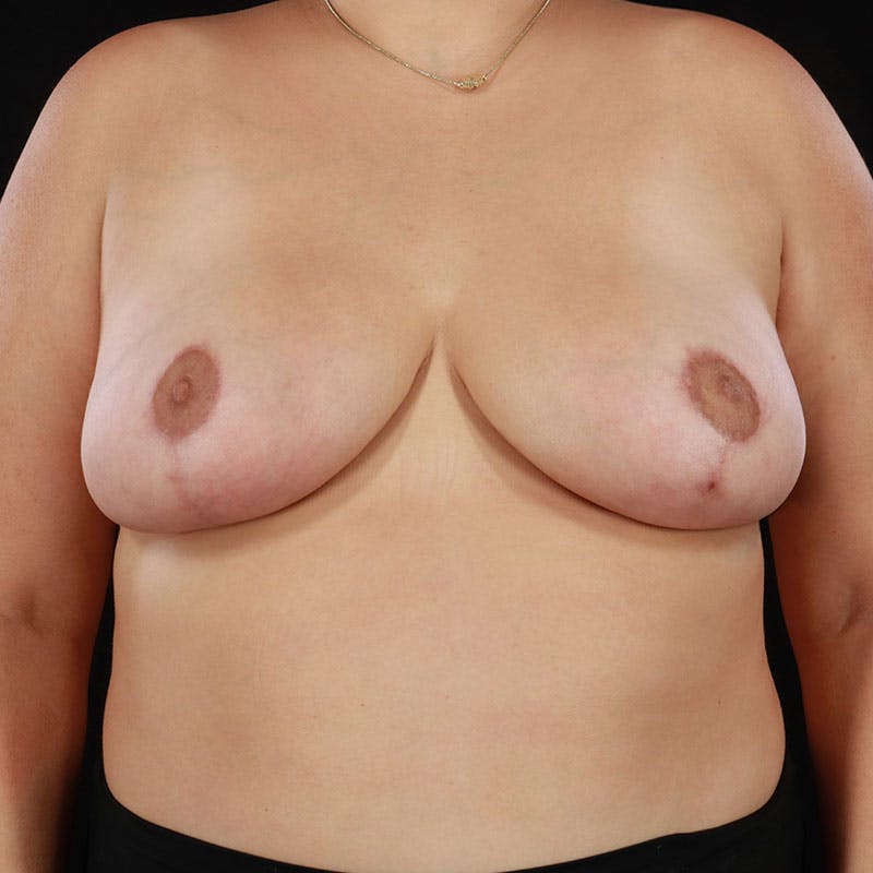Breast Reduction Before & After Gallery - Patient 391007 - Image 4