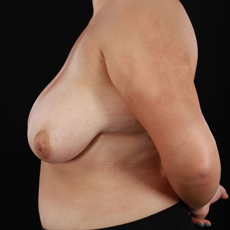 Breast Reduction Before & After Gallery - Patient 391007 - Image 9