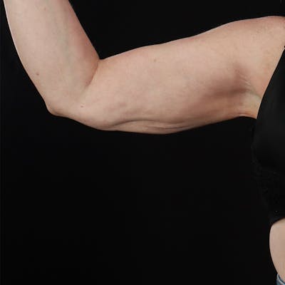 Arm Lift Before & After Gallery - Patient 467386 - Image 1