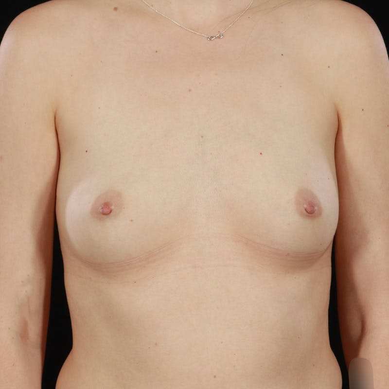 Breast Augmentation Before & After Gallery - Patient 403319 - Image 1