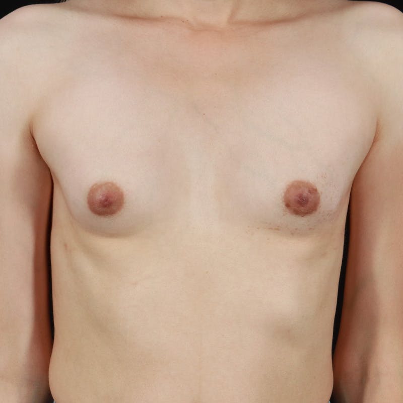 Breast Augmentation Before & After Gallery - Patient 430490 - Image 1