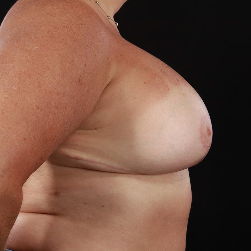 Breast Revision Before & After Gallery - Patient 176678 - Image 6