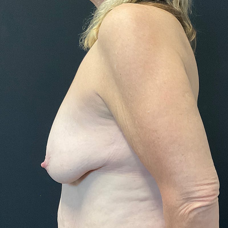 Breast Lift Before & After Gallery - Patient 128164 - Image 9